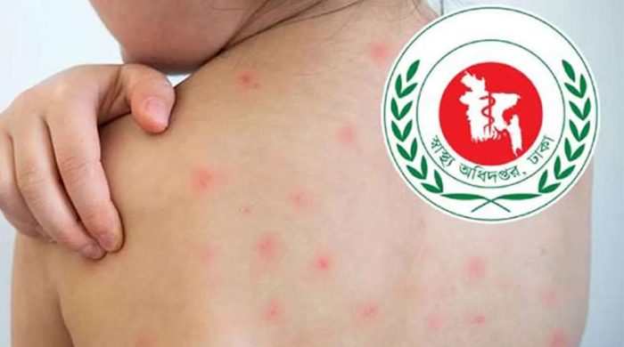 হামে আরও ৫ জনের মৃত্যু, মোট প্রাণহানি ৮৮৫