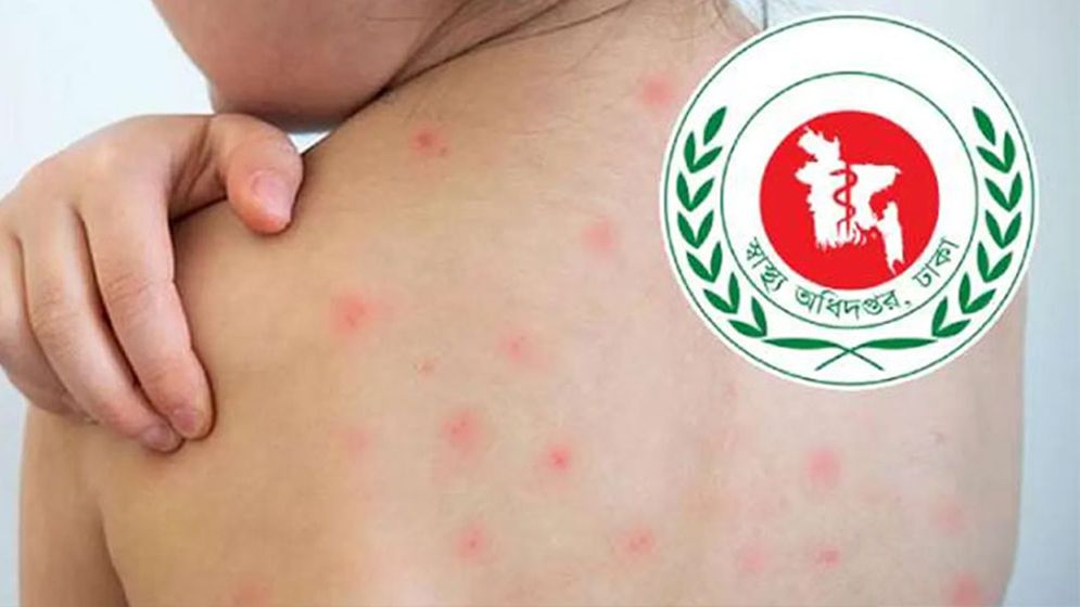 হামে আরও ৫ জনের মৃত্যু, মোট প্রাণহানি ৮৮৫